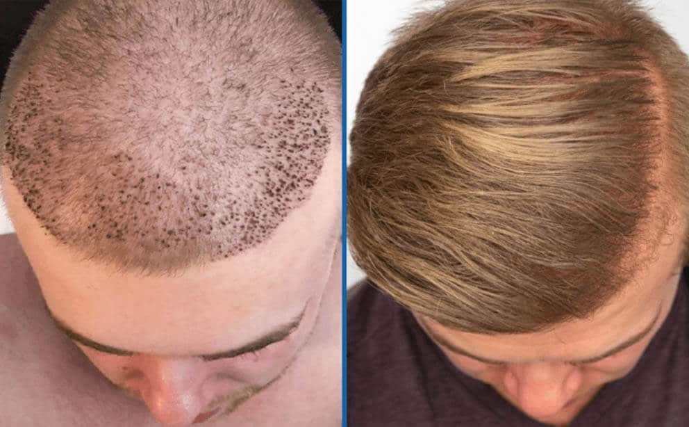 hair-transplant-method Saç Ekimi - Op. Dr. Ertan Günal Gaziantep