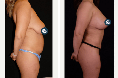 mommy-makeover-before-and-after Mommy Makeover - Op. Dr. Ertan Günal Gaziantep